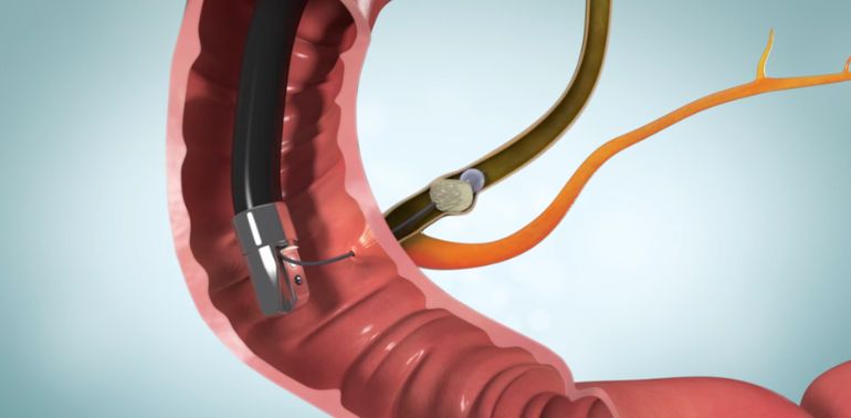 Endoscopic Retrograde Cholangiopancreatography (ERCP)