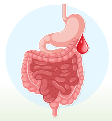 Treatment of GI bleeding