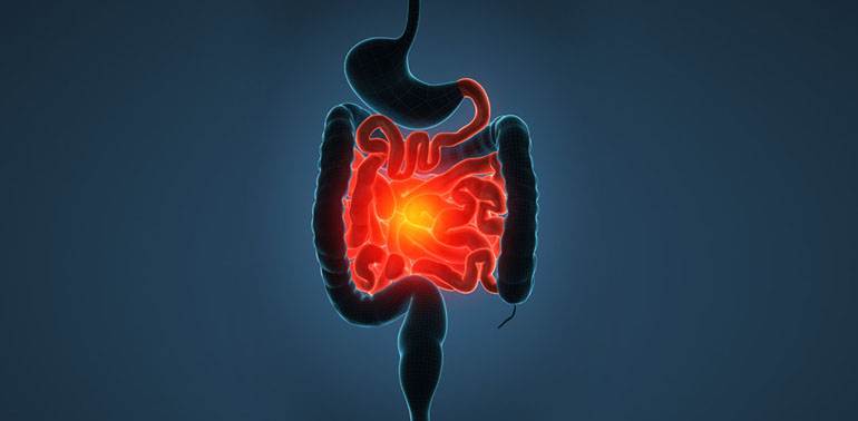 Inflammatory bowel disease (IBD)